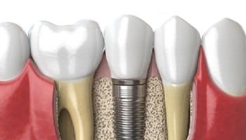 Diagram of dental implant in Mesquite after placement