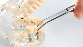 Mesquite implant dentist placing final restoration on model 