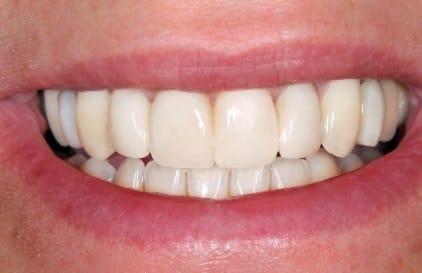 Flawless smile after cosmetic dentistry