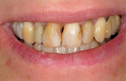 Damaged smile before cosmetic dentistry