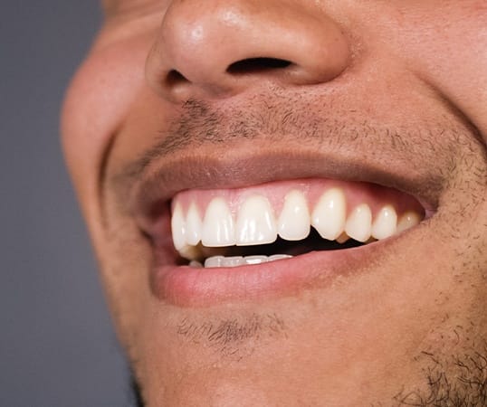 Smile after gum recontouring