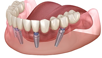 Diagram showing how implant dentures in Mesquite work 