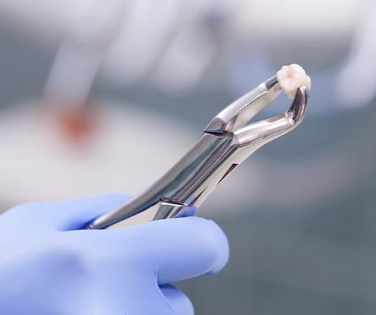 Metal clasp holding an extracted wisdom tooth