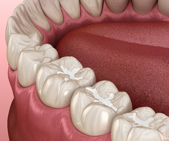 A 3D close-up of tooth-colored fillings in Mesquite