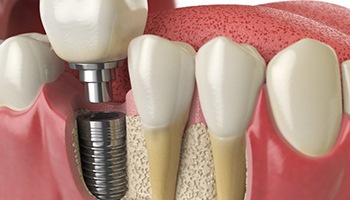 diagram of dental implant in Mesquite showing the jawbone