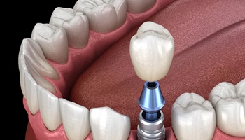 Illustration of implant, abutment, and crown being placed in mouth