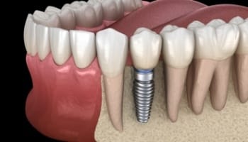 Animated dental implant supported dental crown