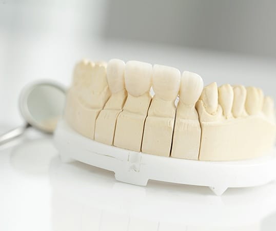 Model smile with dental bridge