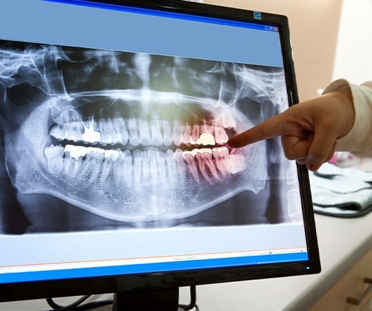 Digital dental x-rays on chairside computer