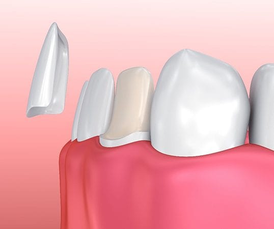 Closeup illustration of veneers procedure