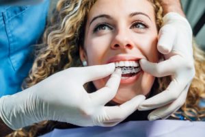 a dentist placing aligners into a patient’s mouth