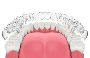 Illustration of Invisalign being placed over the teeth