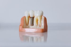 Model of a dental implant